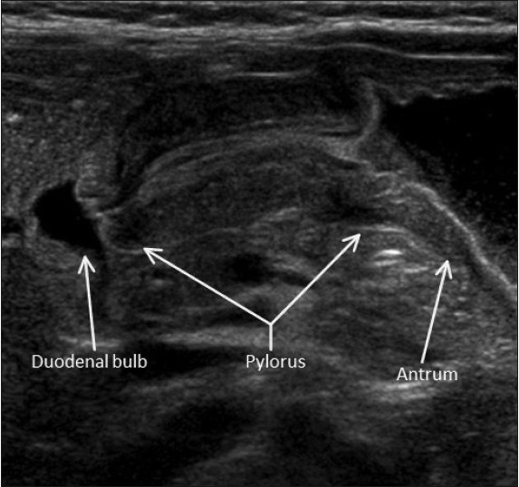 pyloric stenosis ultrasound